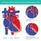 Atrial Septal Defect ASD and Ventricular Septal Defect VSD. Abnormal of the heart atrial and heart ventricle