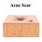 Atrophic scars. Acne scar. The anatomical structure of the skin with acne. Vector illustration on isolated background.