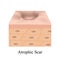 Atrophic scars. Acne scar. The anatomical structure of the skin with acne. Vector illustration on isolated background.
