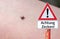 Attention ticks Warning sign with a tick on the arm in german
