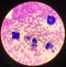 Atypical cells in body fluid smear