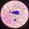 Atypical cells in body fluid smear