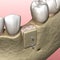 Augmentation Surgery - Bone transplantation, preparing for implantation. 3D illustration