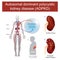 Autosomal dominant polycystic kidney disease.