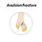 Avulsion fracture Bone. Infographics. Vector illustration on a lined background.