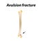 Avulsion fracture Bone. Infographics. Vector illustration on a lined background.
