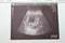 Baby b ultrasonic wave image