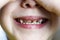 . baby girl is in the chair at the dentist. hands closes his eyes. front teeth in caries. shallow depth of cut. there is toning