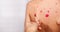 The back is in red dots. The concept of chickenpox. Smear pimples from chickenpox with a cotton bud. Banner. A place for text.