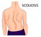 Back, a scoliosis of the fourth degree