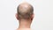 Back shot of a male head of thin hair