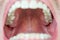 Back of the throat, roof of the mouth macro close up view of Caucasian male pharynx