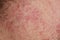 Background with the texture of irritated reddened skin of a man`s neck covered with hair and bristles