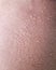 Background texture of pink irritated human skin covered with small wrinkles ,cracks and blistering