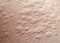 Background of the texture unhealthy irritated human skin is covered with fine wrinkles ,cracked and blistered from the burn and