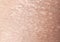 Background of the texture unhealthy irritated human skin covered with small wrinkles ,cracks and blistering