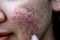 Backgrounds of lesions skin caused by acne on the face.