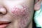 Backgrounds of lesions skin caused by acne on the face.