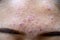 Backgrounds of lesions skin caused by acne on the face.