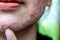 Backgrounds of lesions skin caused by acne on the face.