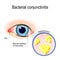 Bacterial conjunctivitis