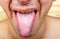 Bacterial infection disease tongue