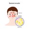 Bacterial sinusitis. Rhinitis