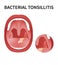 Bacterial and viral tonsillitis. Angina, pharyngitis, and tonsillitis.