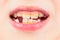 Bad teeth child. Portrait boy with bad teeth. Child smile and show her crowding tooth. Close up of unhealthy baby teeths