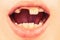 Bad teeth child. Portrait boy with bad teeth. Close up of unhealthy baby teeths. Kid patient open mouth showing cavities