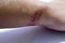 Badly healed burn on Caucasian young man`s wrist