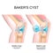 Baker`s cyst. Normal knee, and joint with Popliteal cyst