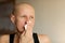 Bald cancer sick woman blowing running nose got flu cough cold, rhinitis sneezing in tissue or nosebleeds. Female is