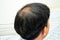 Bald at front of head and begin no loss hair glabrous of mature Asian business smart active office man