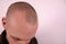 Bald head. A guy who begins to be thin-haired