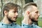 Bald man before after haircut Concept for a barber shop: the problem man of hair loss, alopecia, transplantation, side