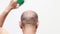 Bald man using hair restorer