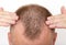 Bald patches on the head of a young man. The concept of the increased hormone dihydrotestosterone. Weakening of hair