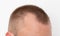 Bald patches on the head of a young man. The concept of the increased hormone dihydrotestosterone. Weakening of hair follicles