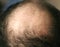 A bald spot on a man`s head. Alopecia. Hair loss