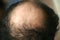 A bald spot on a man`s head. Alopecia. Hair loss