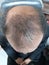 A bald spot on man`s head indicating the hair loss pattern.