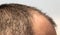Bald spots on the head of a man