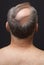 Balding Man\'s Head