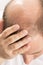 Baldness Alopecia man hair loss