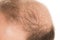 Baldness Alopecia man hair loss haircare