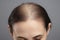 Baldness head scalp problem. Generate ai