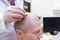 Baldness treatment. Patient suffering from hair loss in consultation with a doctor. Preparation for hair transplant