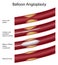 Balloon angioplasty procedure