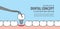 Banner Implant tooth install illustration vector on blue backgro